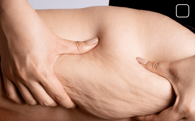 Leia mais sobre o artigo Conselho de Medicina promove evento inédito “Lipedema em Foco” para debater diagnóstico e tratamento multidisciplinar