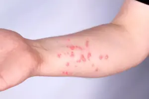 Leia mais sobre o artigo Paciente de 19 anos é isolada por suspeita de monkeypox em Mossoró