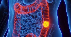 Leia mais sobre o artigo Março Azul-Marinho: Campanha de conscientização sobre o Câncer Colorretal, o segundo mais comum no Brasil