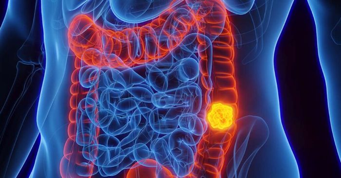 Leia mais sobre o artigo Março Azul-Marinho: Campanha de conscientização sobre o Câncer Colorretal, o segundo mais comum no Brasil