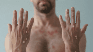 Leia mais sobre o artigo Sesap RN confirma primeiros casos de mpox em 2026