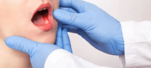 Leia mais sobre o artigo Mucosite Oral: como minimizar os impactos no tratamento do câncer